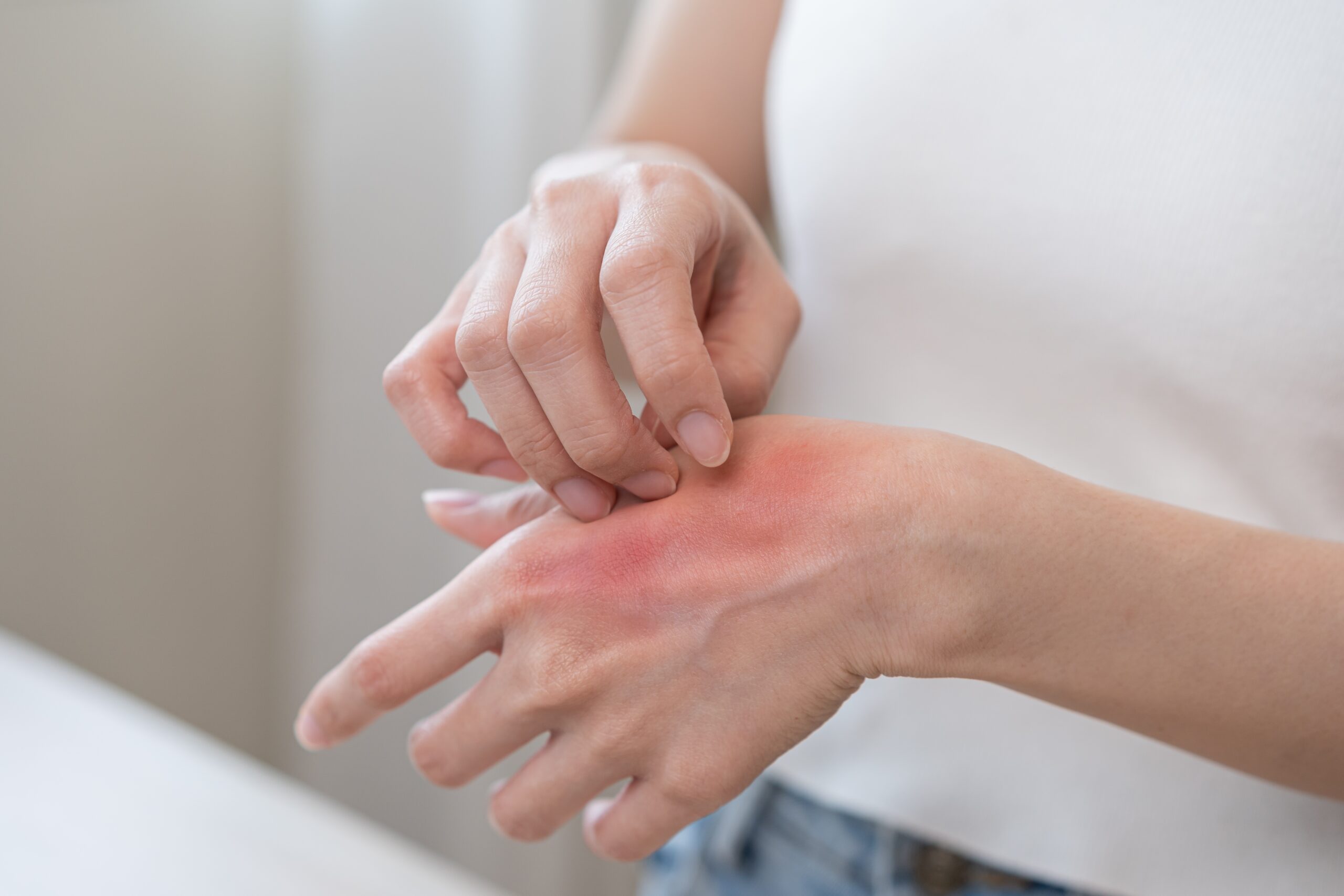 Dermatology,asian,young,woman,allergy,,allergic,reaction,from,atopic,,insect